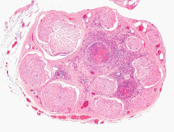1A1 PAN (Case 1) H&E 4X 1
