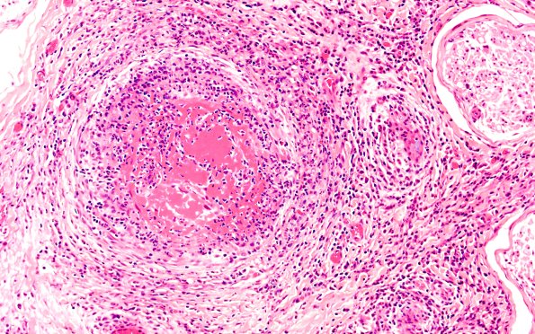 1A2 PAN (Case 1) H&E 20X 1