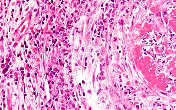 1A3 PAN (Case 1) H&E 20X 1