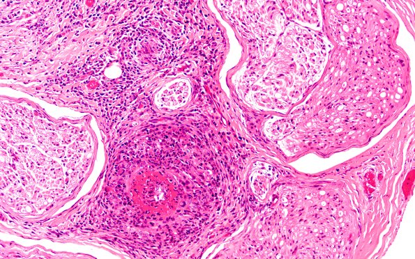 1A4 PAN (Case 1) H&E 20X 2