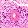 1A6 Vasculitis, P Nodosa (Case 1) H&E 40X 3