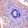 1B5 Vasculitis, P Nodosa (Case 1) PTAH 40X 2