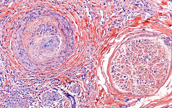1B8 Vasculitis, P Nodosa (Case 1) PTAH