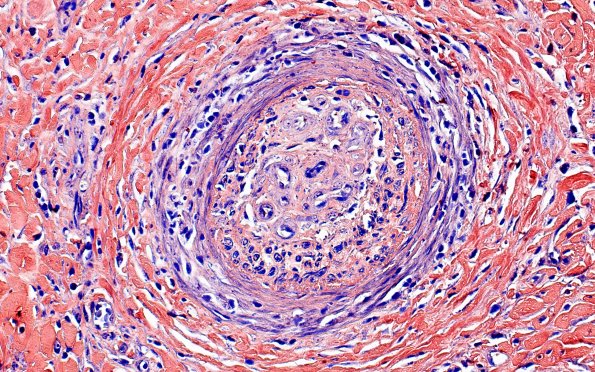 1B9 Vasculitis, P Nodosa (Case 1) PTAH