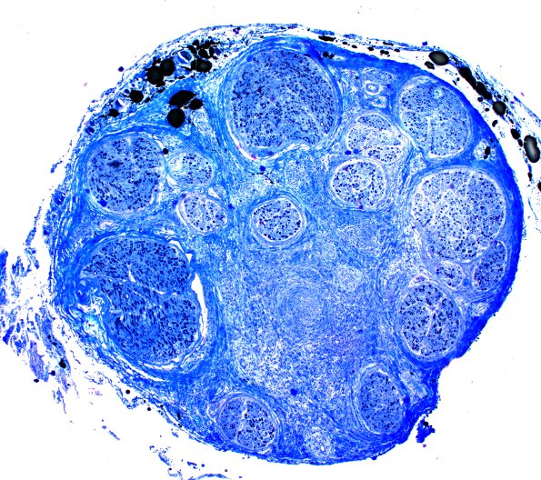 1C1 PAN (Case 1) Plastic 4X 2