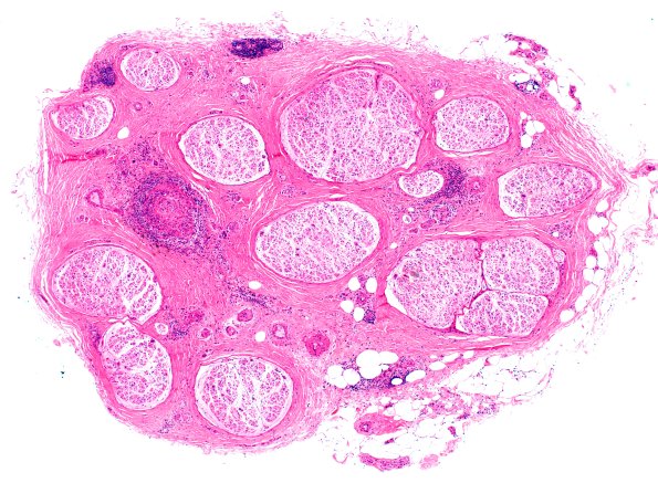 2A1 Vasculitis, PAN (Case 2)  H&E 4X