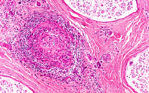 2A2 Vasculitis, PAN (Case 2)  H&E 20X