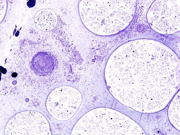 2B1B Vasculitis, Polyarteritis Nodosa (Case 2) Plastic 45