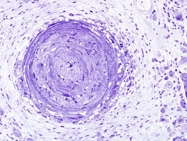 2B1C Vasculitis, Polyarteritis Nodosa (Case 2) Plastic 48
