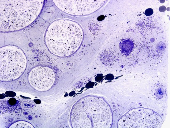 2B2B Vasculitis, Polyarteritis Nodosa (Case 2) Plastic 18