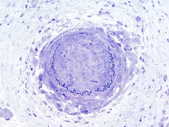 2B2C  Vasculitis, Polyarteritis Nodosa (Case 2) Plastic 26