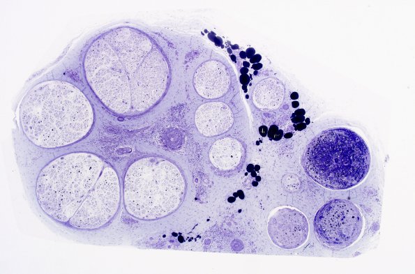 2B3A Vasculitis, Polyarteritis Nodosa (Case 2) Plastic 40