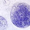 2B3C-Vasculitis-PAN-Case 2-Plastic-7.jpg