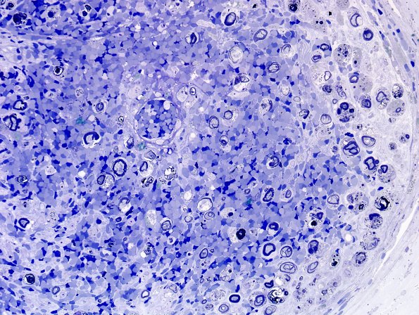 2B3D Vasculitis, Polyarteritis Nodosa (Case 2) Plastic 7
