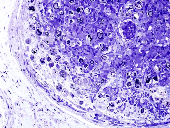 2B3E Vasculitis, Polyarteritis Nodosa (Case 2) Plastic 34