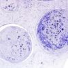 2B3F-Vasculitis-PAN-Case 2-Plastic-3.jpg