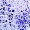 2B3G-Vasculitis-PAN-Case 2-Plastic-13.jpg