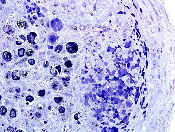 2B3G-Vasculitis-PAN-Case 2-Plastic-13.jpg