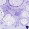 2B3H Vasculitis, Polyarteritis Nodosa (Case 2) Plastic 35