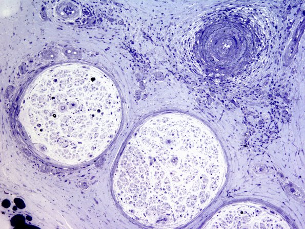 2B3I-PAN-Case 2-Plastic-10.jpg