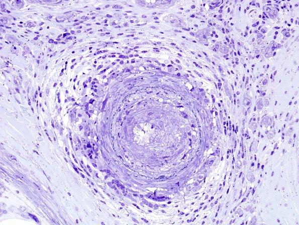 2B3K Vasculitis, Polyarteritis Nodosa (Case 2) Plastic 37