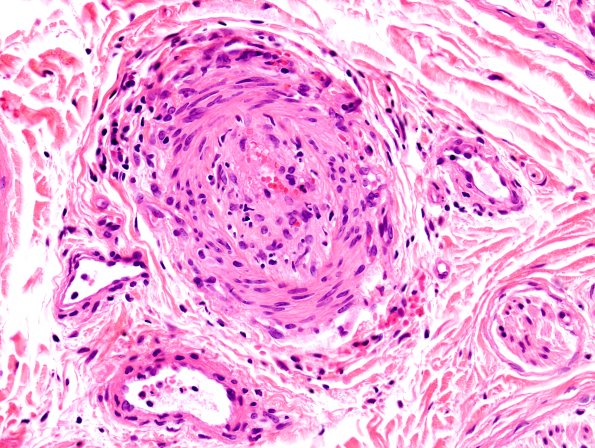 3A2 Vasculitis, PAN (Case 3) Pentachrome 2
