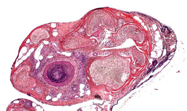 5A1 PAN (Case 5) PTAH 4X