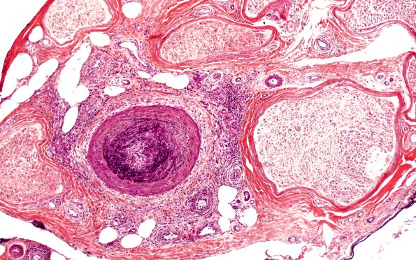 5A2 PAN (Case 5) PTAH 10X