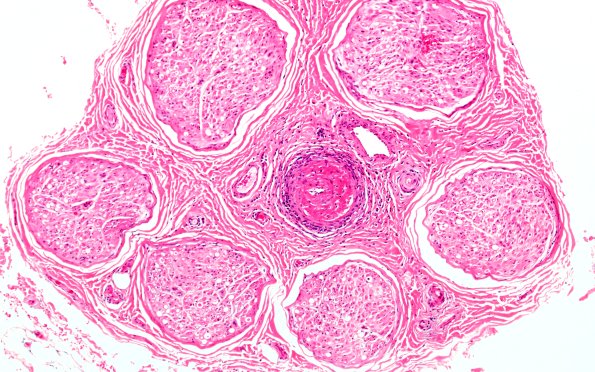 6A1 PAN (Case 6) H&E 10X 2