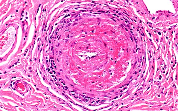 6A2 PAN (Case 6) H&E 40X 1