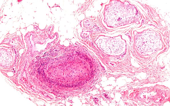 6A3 PAN (Case 6) H&E 10X 1
