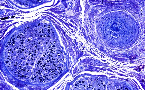 6B1 PAN (Case 6) Plastic 20X