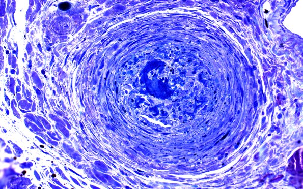 6B2 PAN (Case 6) Plastic 40X