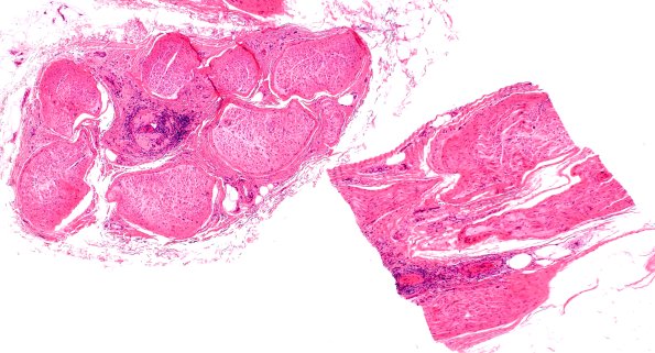 7A1 PAN (Case 7) H&E 4X