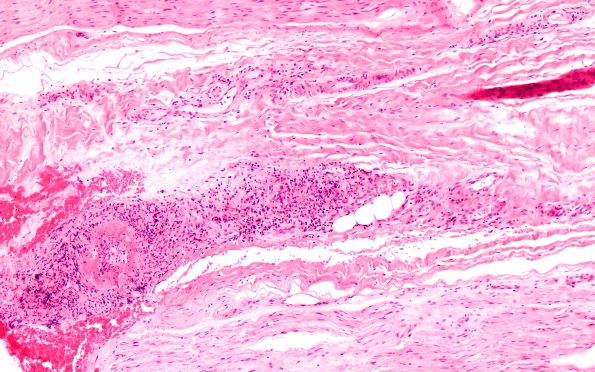 8A1 PAN (Case 8) H&E 10X 1