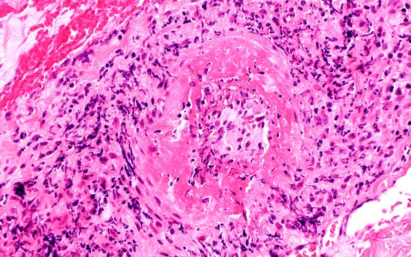 8A2 PAN (Case 8) H&E 40X 1