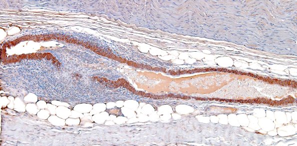 8B1 Vasculitis (Case 8) SMA 8