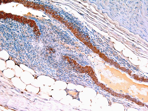 8B2 Vasculitis (Case 8) SMA 11