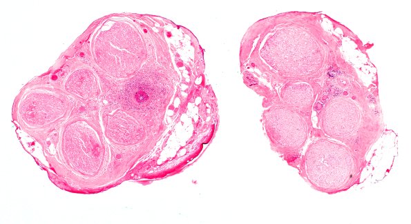 9A1 (Case 9) H&E 4X 2