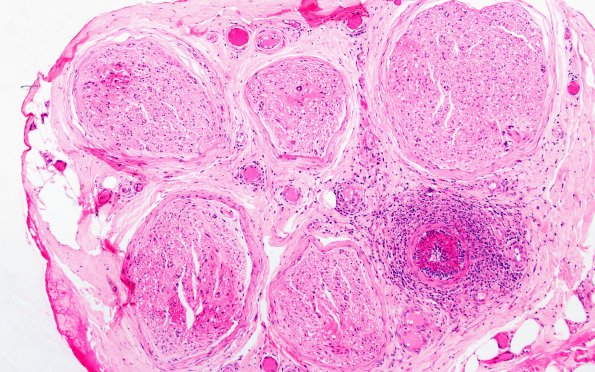 9A2 (Case 9) H&E 10X