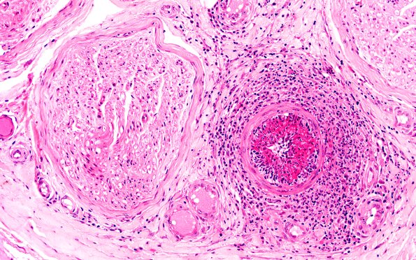 9A3 (Case 9) H&E 20X 2