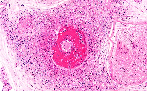 9A4 (Case 9) H&E 20X