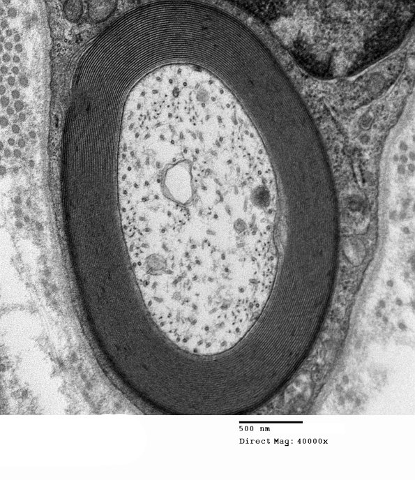 0A4 Anti-MAG NP (Case 0) EM 008 - Copy