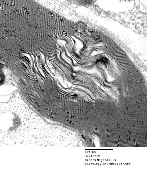 10A2 Artifact, separation myelin, Amiodarone (Case 10)_006a - Copy (2) - Copy