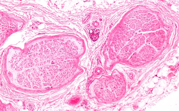 1A2 Anti-MAG Neuropathy (Case 1) H&E 10X 1