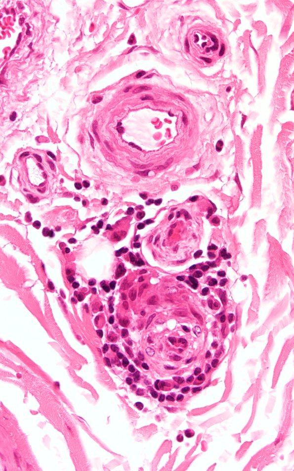 1A3 Anti-MAG Neuropathy (Case 1) H&E 60X 1