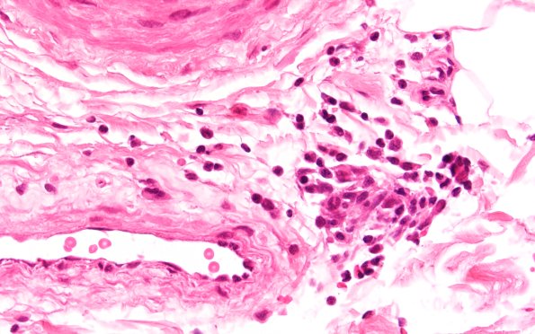 1A4 Anti-MAG Neuropathy (Case 1) H&E 60X 2