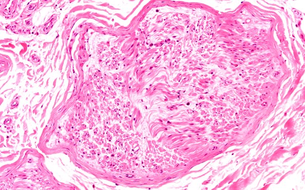 1A5 Anti-MAG Neuropathy (Case 1) H&E 20X 2