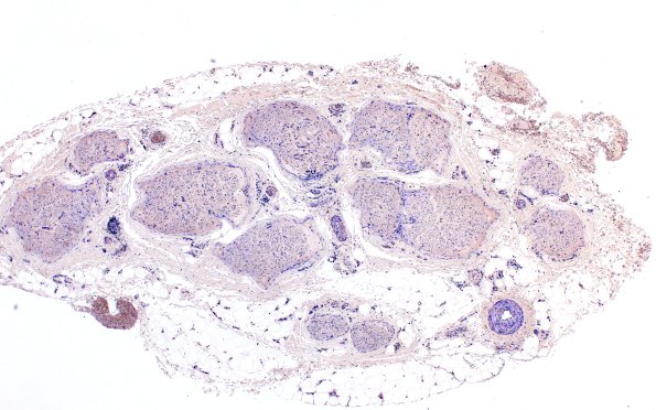 1B1 Anti-MAG Neuropathy (Case 1) Neg Control 4X 2