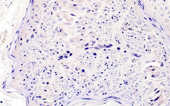 1B3 Anti-MAG Neuropathy (Case 1) Neg Control 40X 2